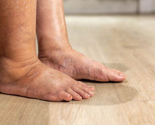 Inchaço nas pernas e nos olhos: quando pode ser sinal de problema nos rins?